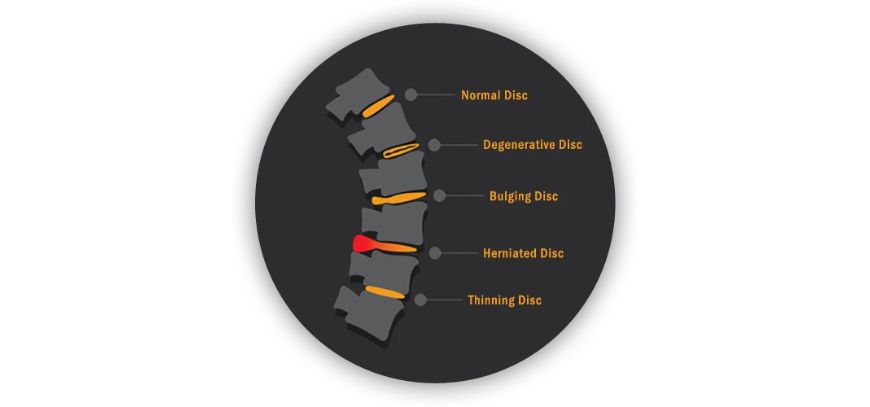 spinal decompression orange county ca